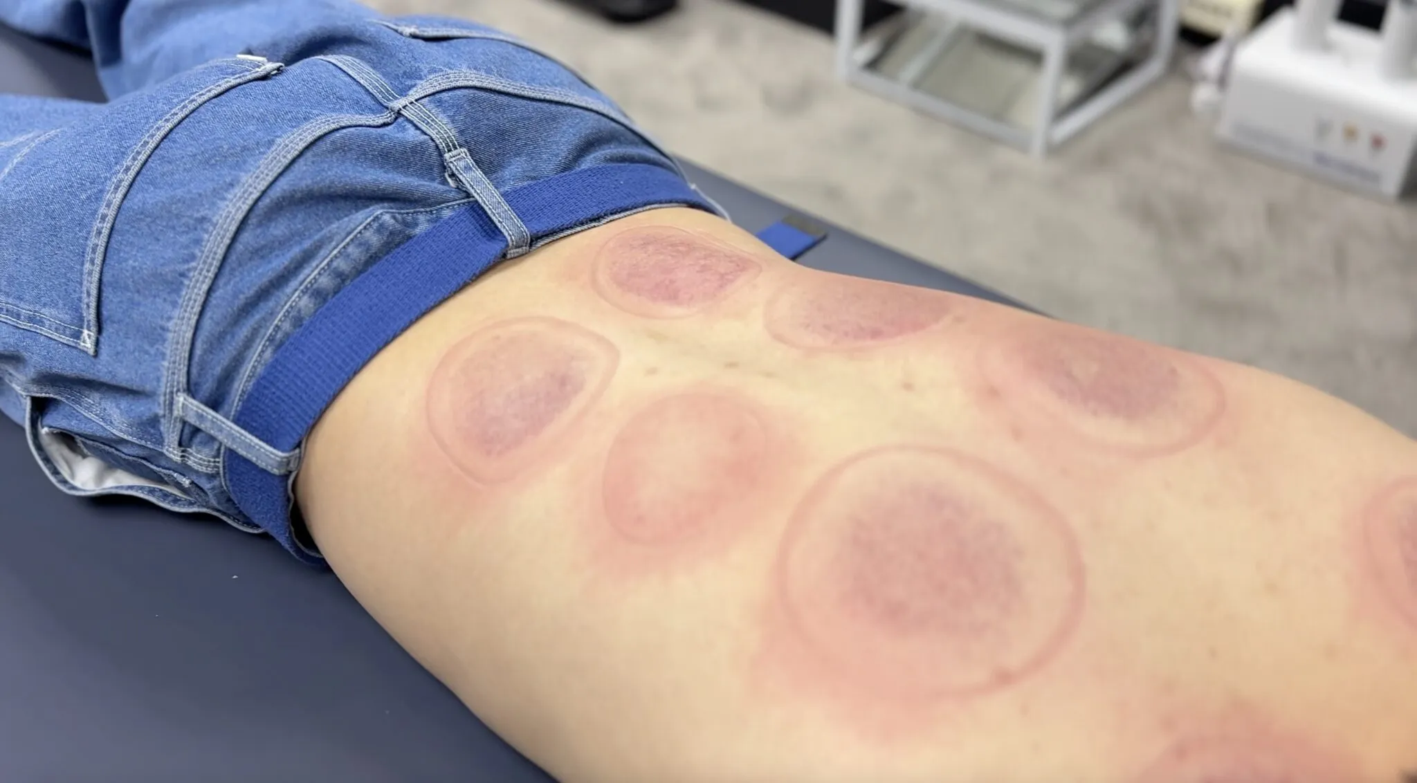 Professional dry cupping therapy Manchester at Hekas Sports Therapy clinic 1