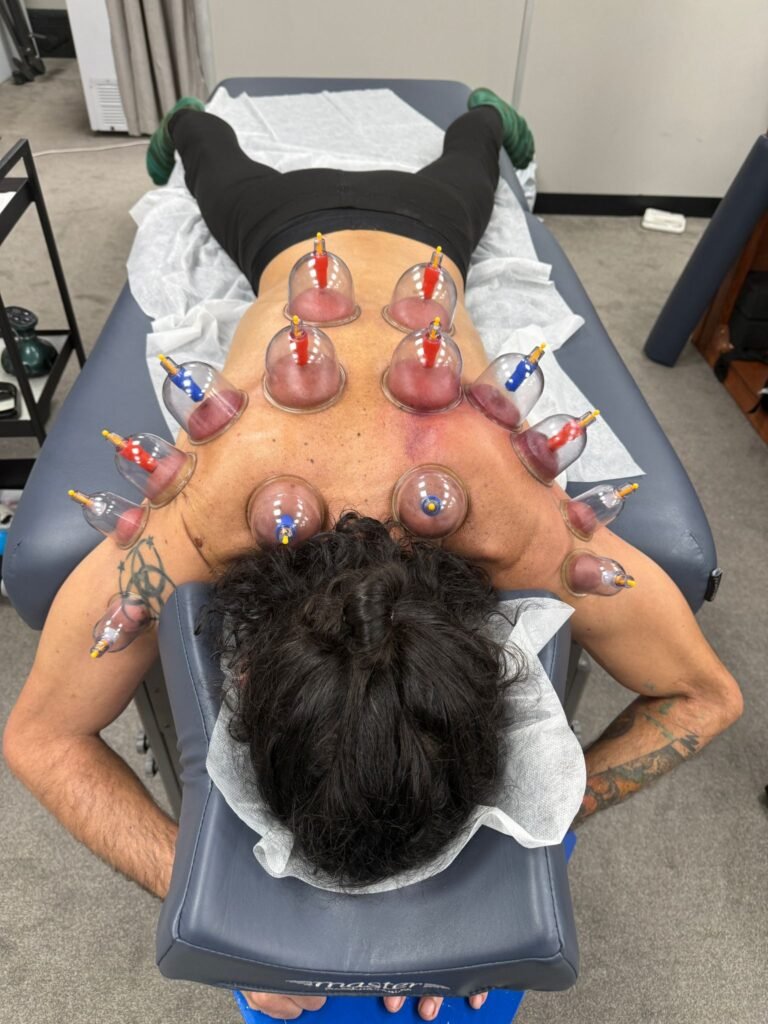 Professional dry cupping therapy Manchester at Hekas Sports Therapy clinic