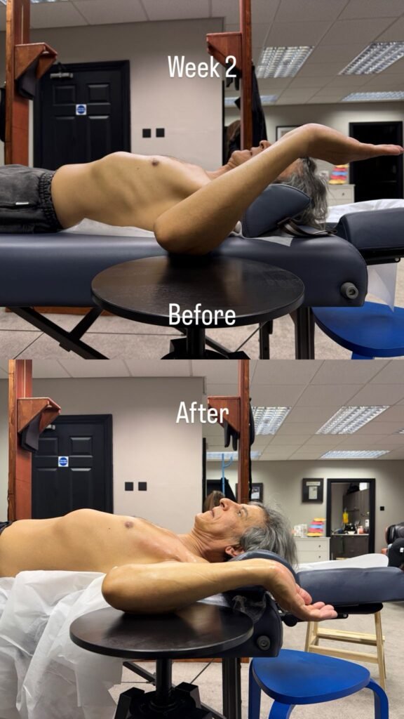 Functional rehab progress before and after